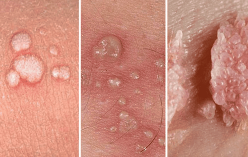 How do we know that we have genital warts or pimples and herpes in women