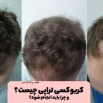 What is carboxy therapy?