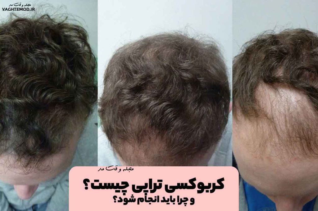 What is carboxy therapy?