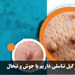 How do we know that we have genital warts or pimples and herpes