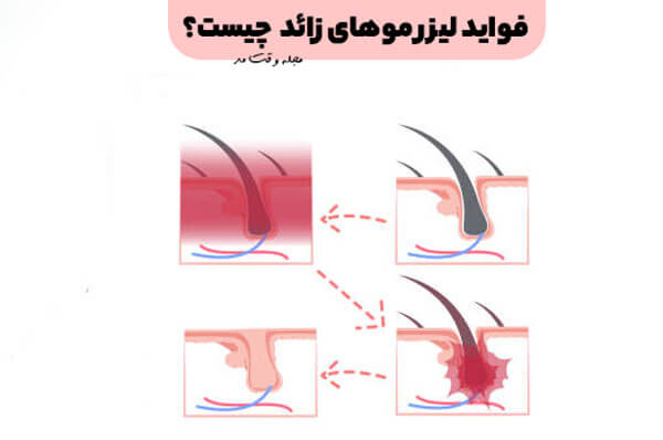 The benefits and benefits of laser hair removal