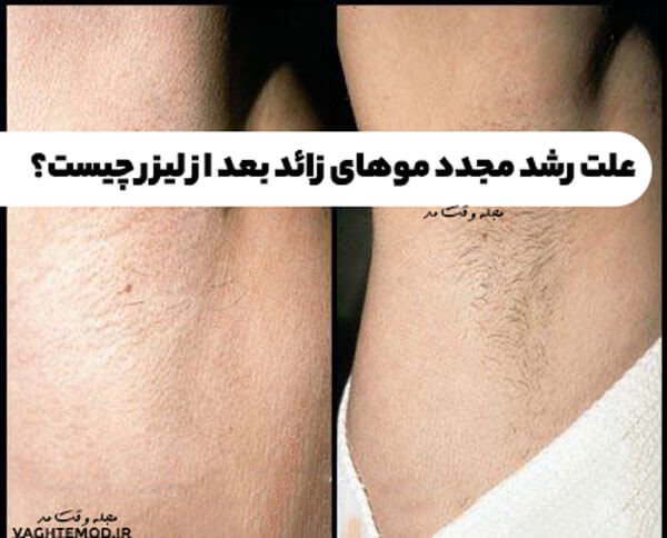 The cause of the re -rise of hair removal after laser