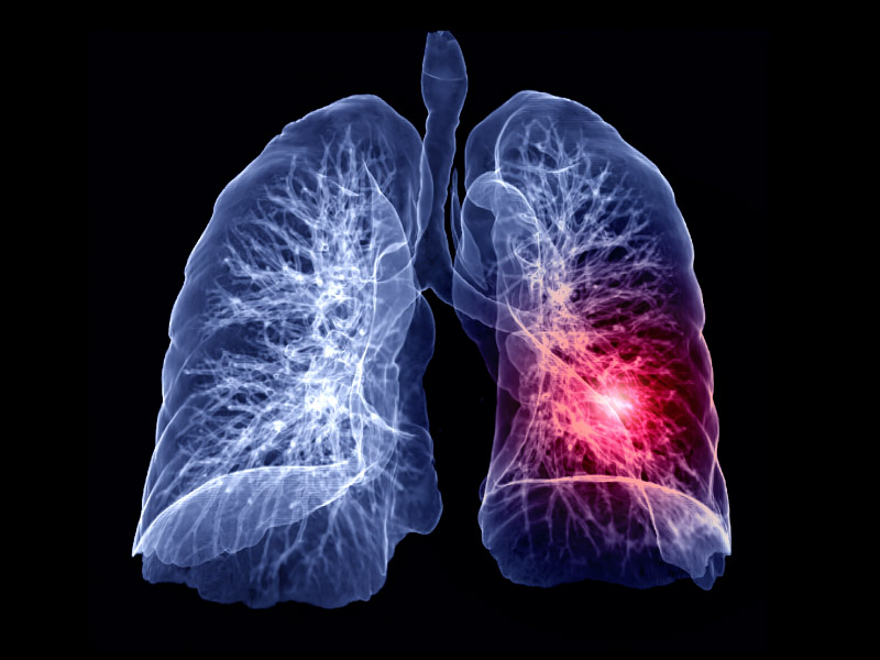 Complications after the treatment of lung embolism