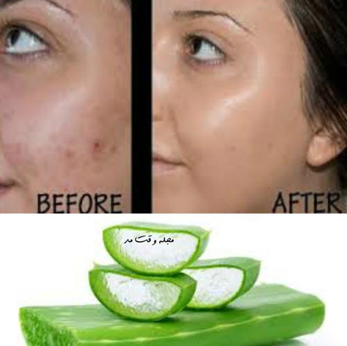 Use aloe vera to treat the facial subcutaneous pimples with the image before and after 