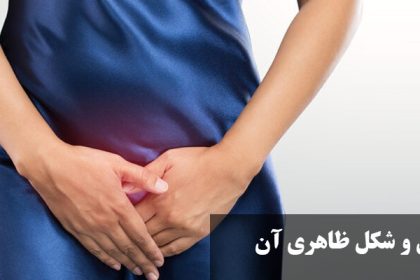 Symptoms of genital herpes in women and its appearance