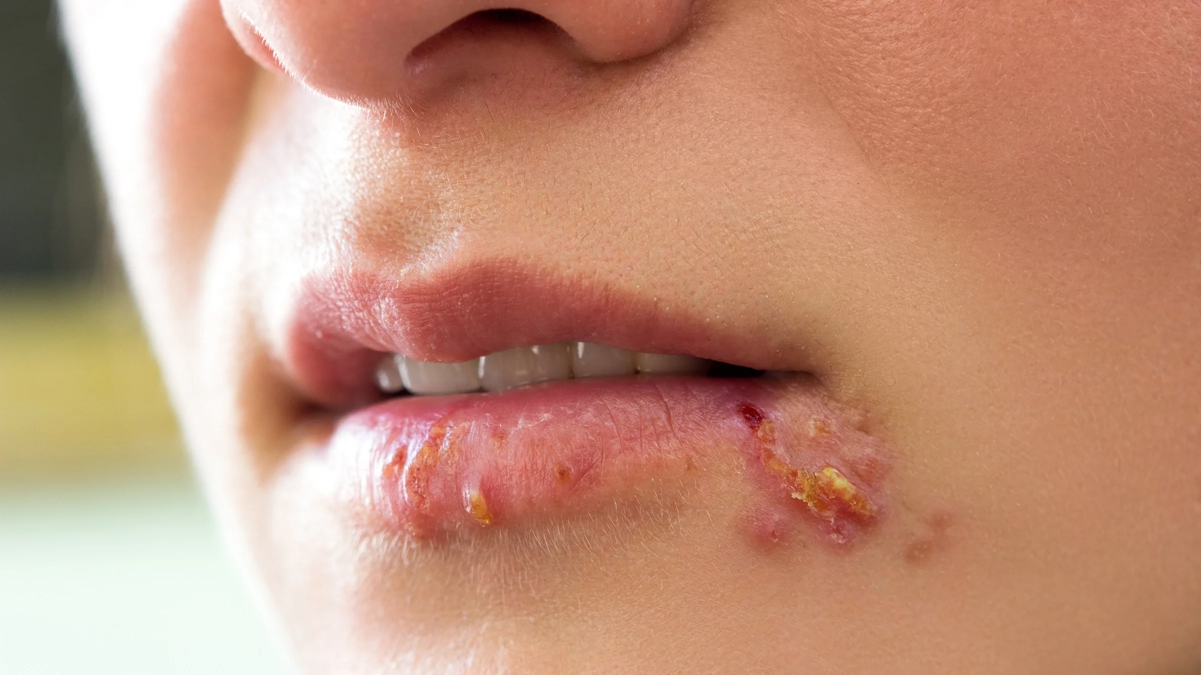 The cause of genital herpes in women