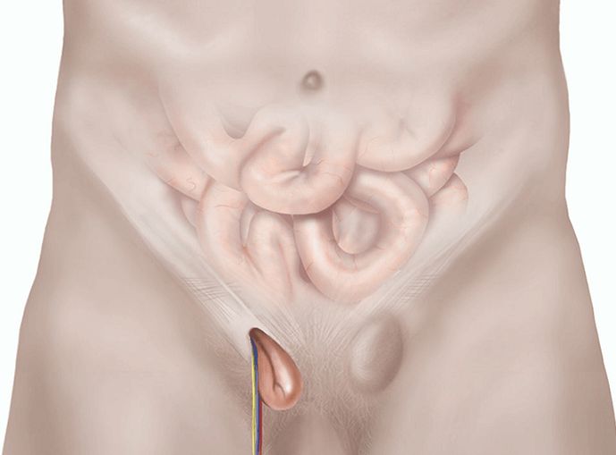 What are the symptoms of a testicular hernia