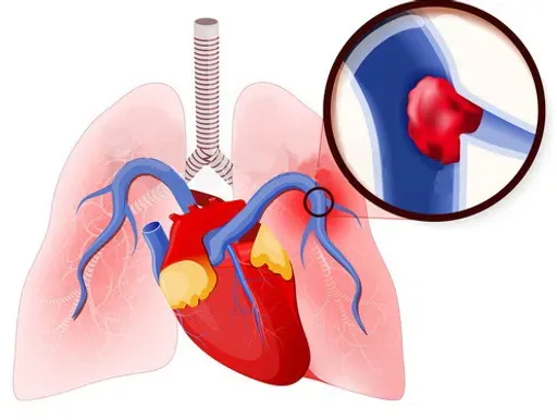 What causes lung embolism?