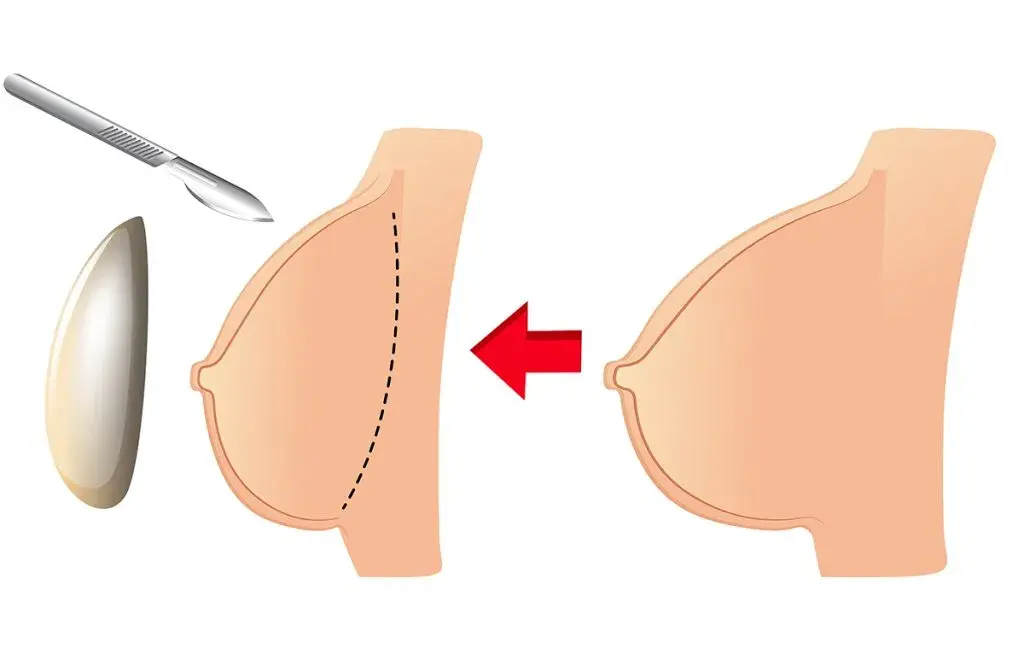 Post -Mammoplasty Picture