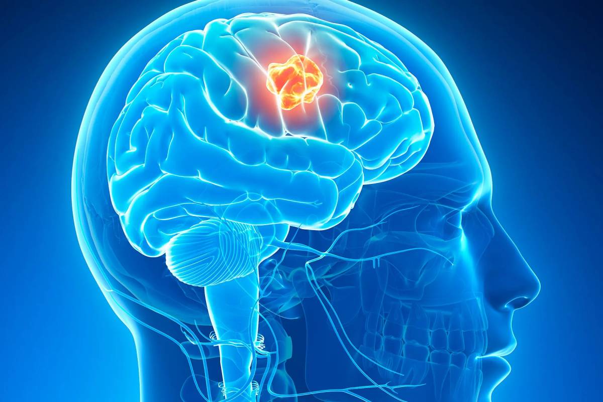 Brain Cancer Treatment of brain cancer