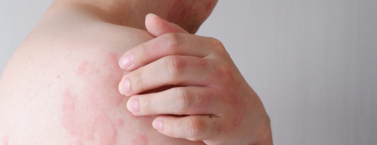 The strongest anti-allergic skin pill