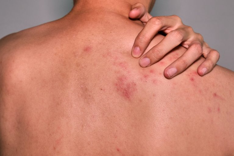 The best ointment for pimples on the back