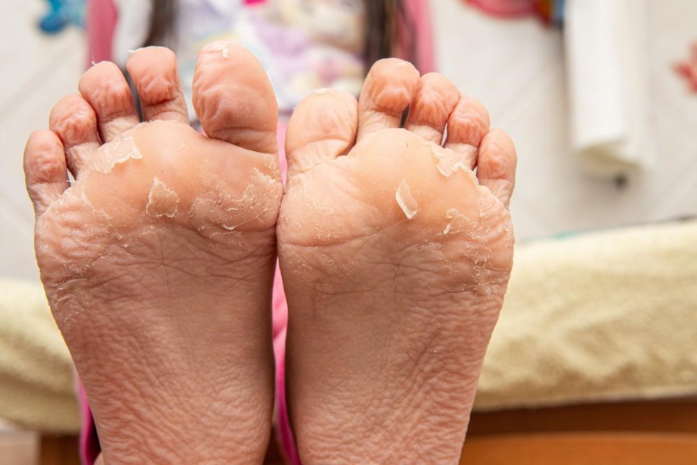 What vitamin is the cause of skin peeling on the soles of the feet?