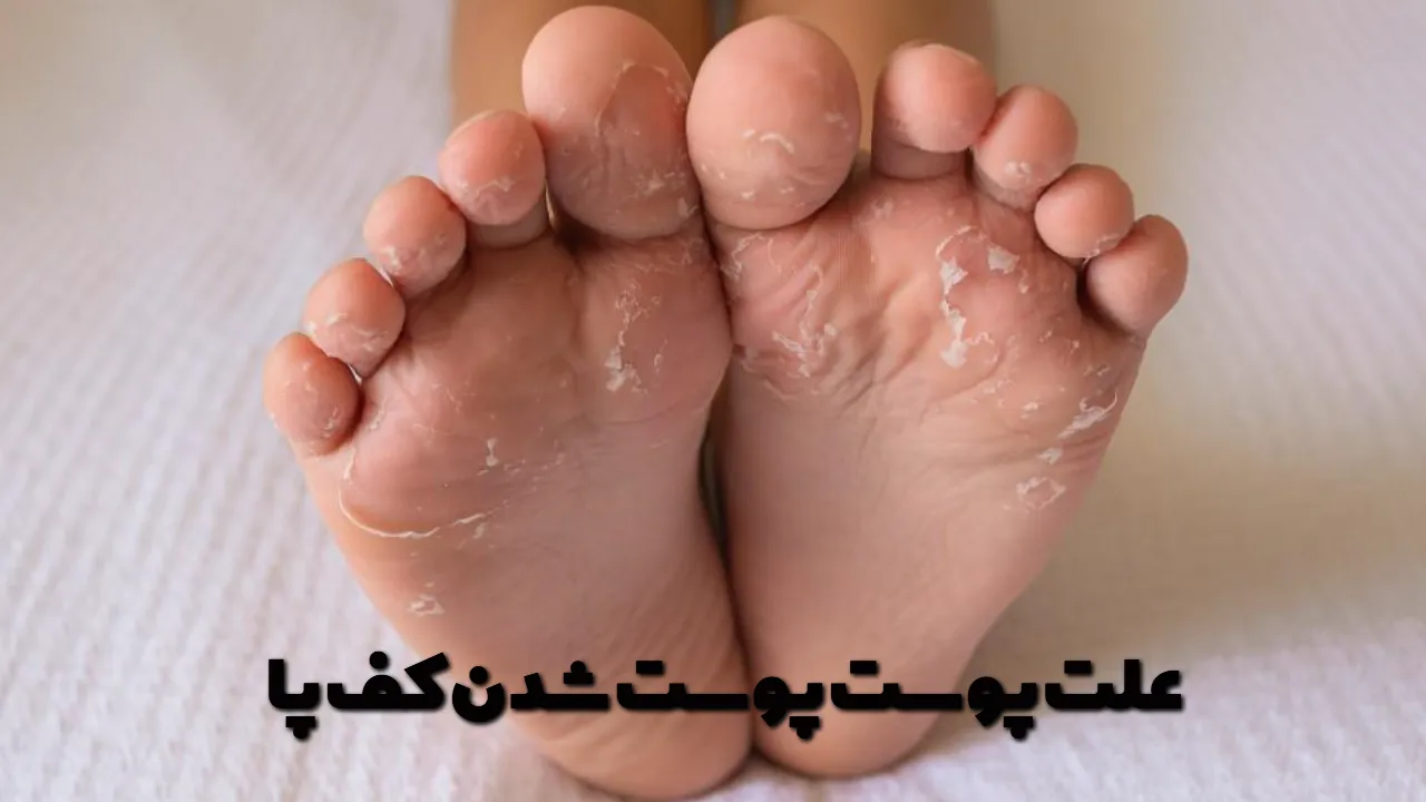 The cause of skin peeling on the soles of the feet