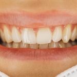 Why are teeth not considered bones? - Diginoy