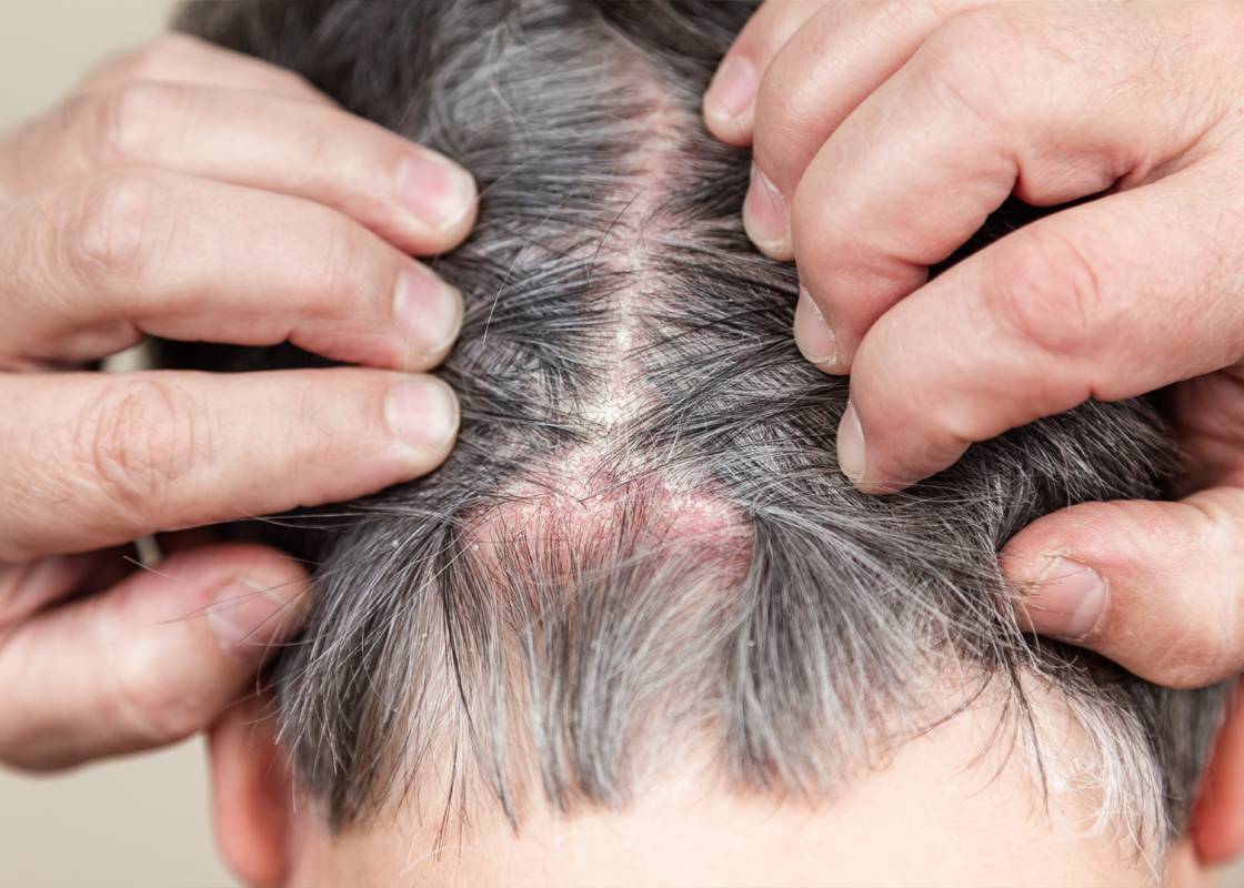 The cause of burning in the head