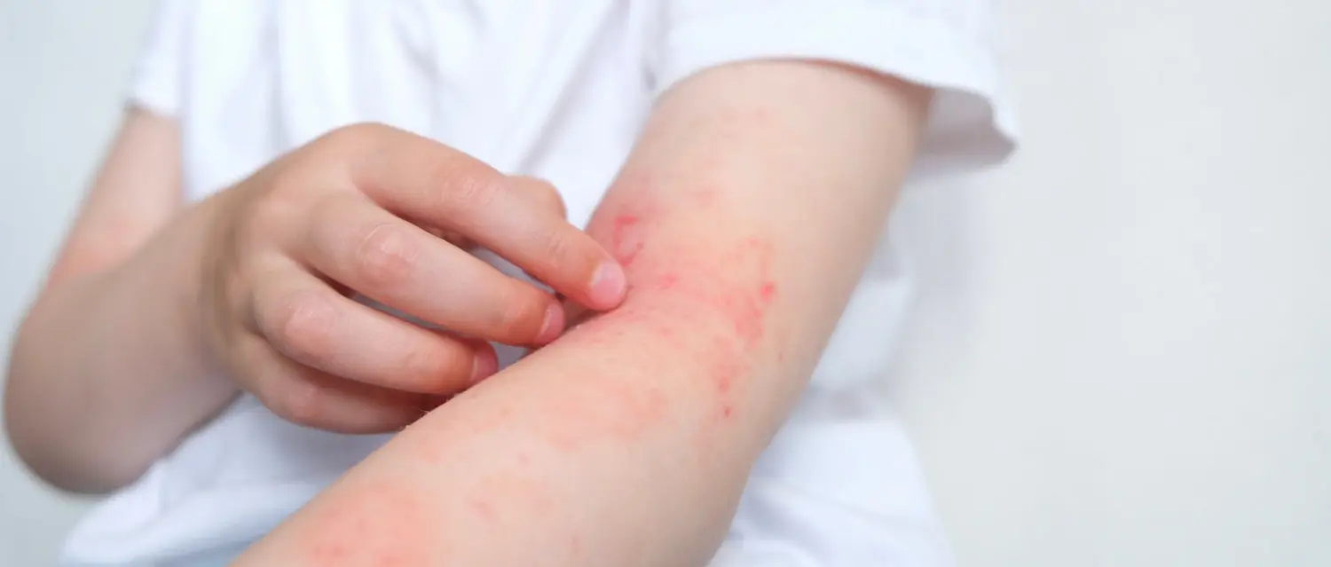 Home treatment of eggplant allergy What to do for eggplant allergy?