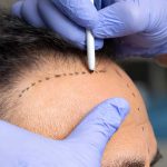 Hair transplant in Shiraz with anesthesia