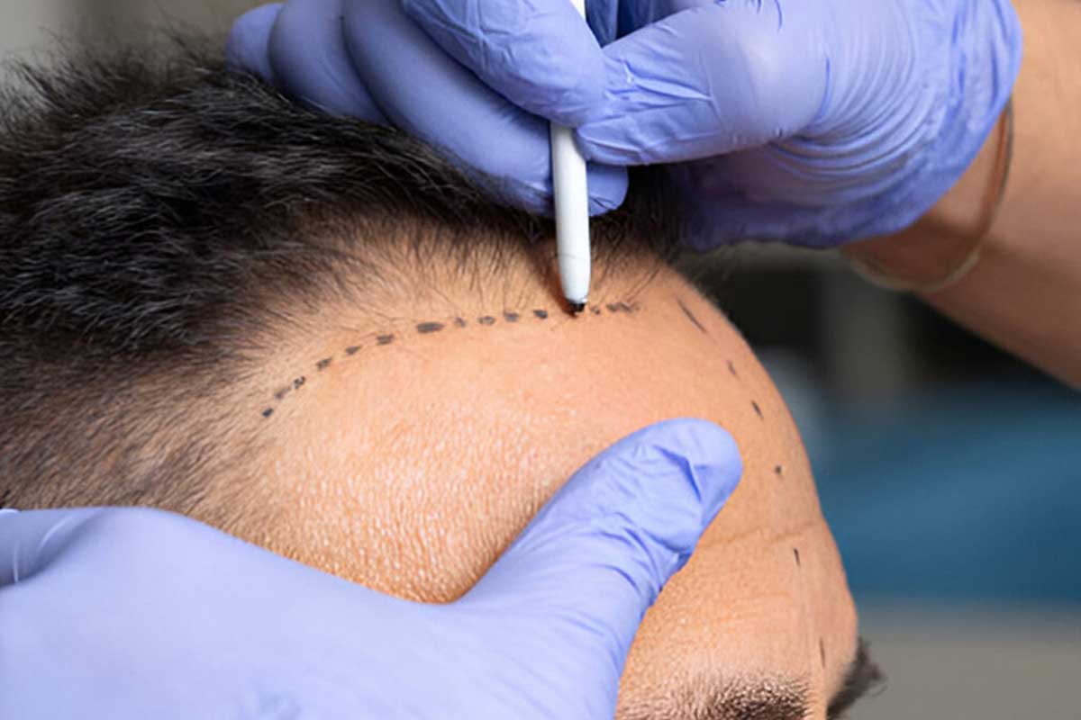 Hair transplant in Shiraz with anesthesia