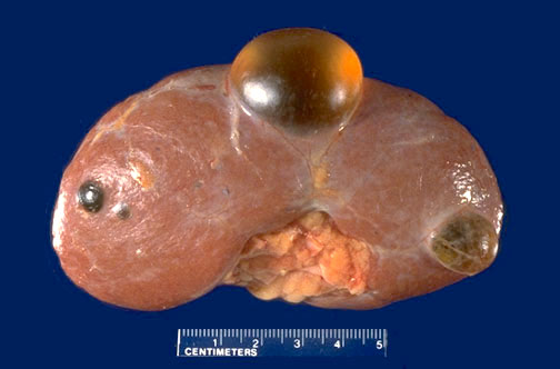 How dangerous is the size of a kidney cyst?