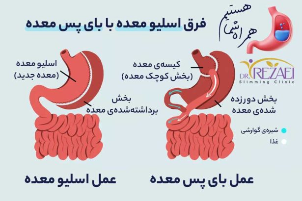 The difference between gastric sleeve and gastric bypass - Dr. Rezaei obesity surgeon