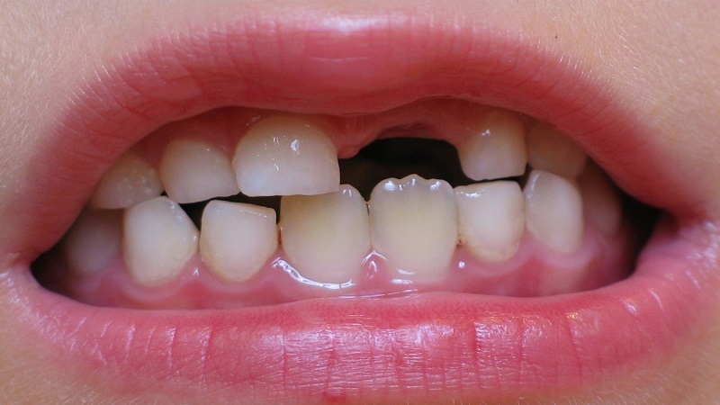 The cause of late eruption of permanent teeth after the fall of milk teeth