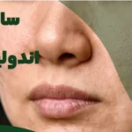 What is subcision with endolift?