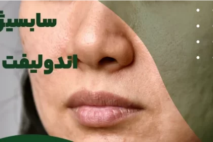 What is subcision with endolift?