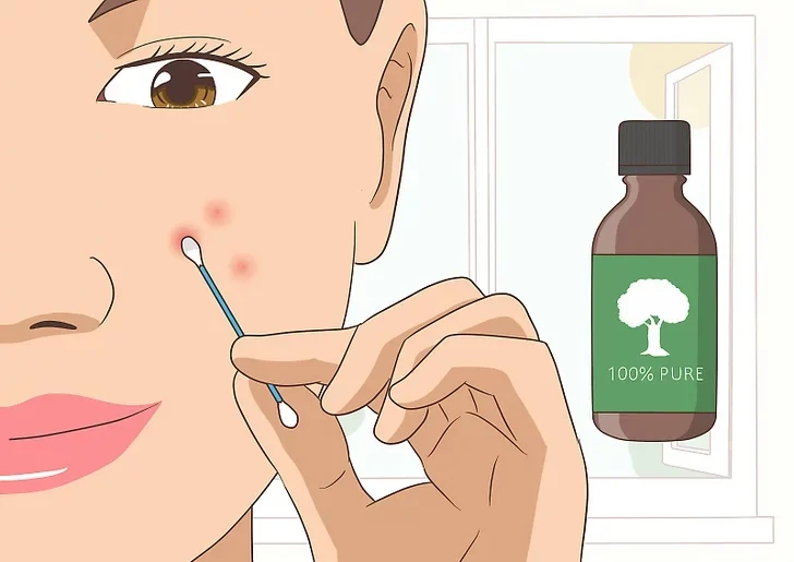 The role of tea tree oil in acne control