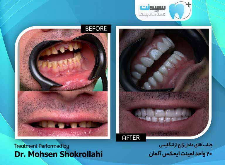 Dental laminate photo