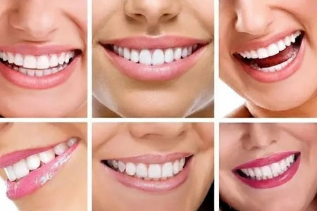 Correcting the smile design with laminate or composite?