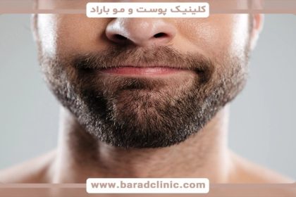 The best beard and mustache transplant doctor and a complete guide to having a thick and natural beard in Barad Clinic